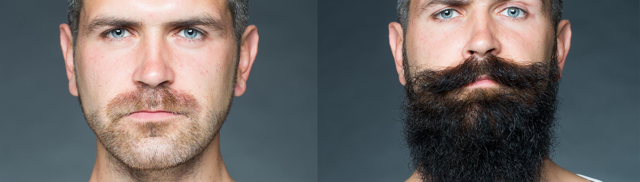 Belladonna-Beard transplantation
